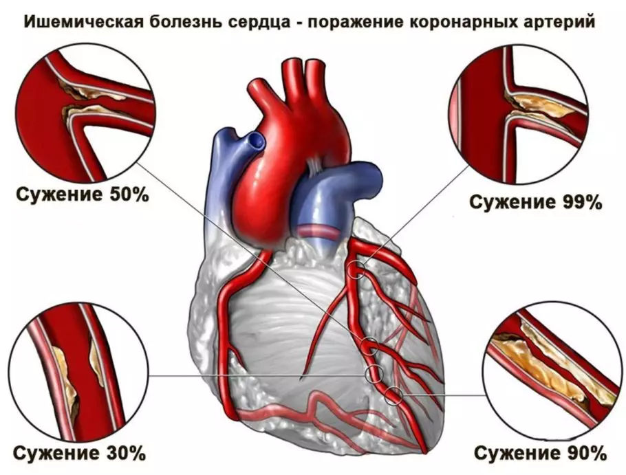 Схема поражения коронарных артерий при ишемической болезни