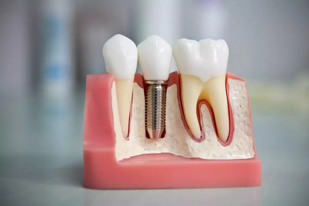 Протезирование зубов в Перово: новые технологии для восстановления улыбки