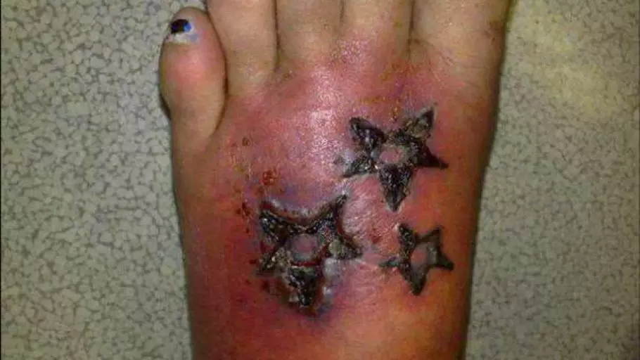 воспаление татуировки на ноге