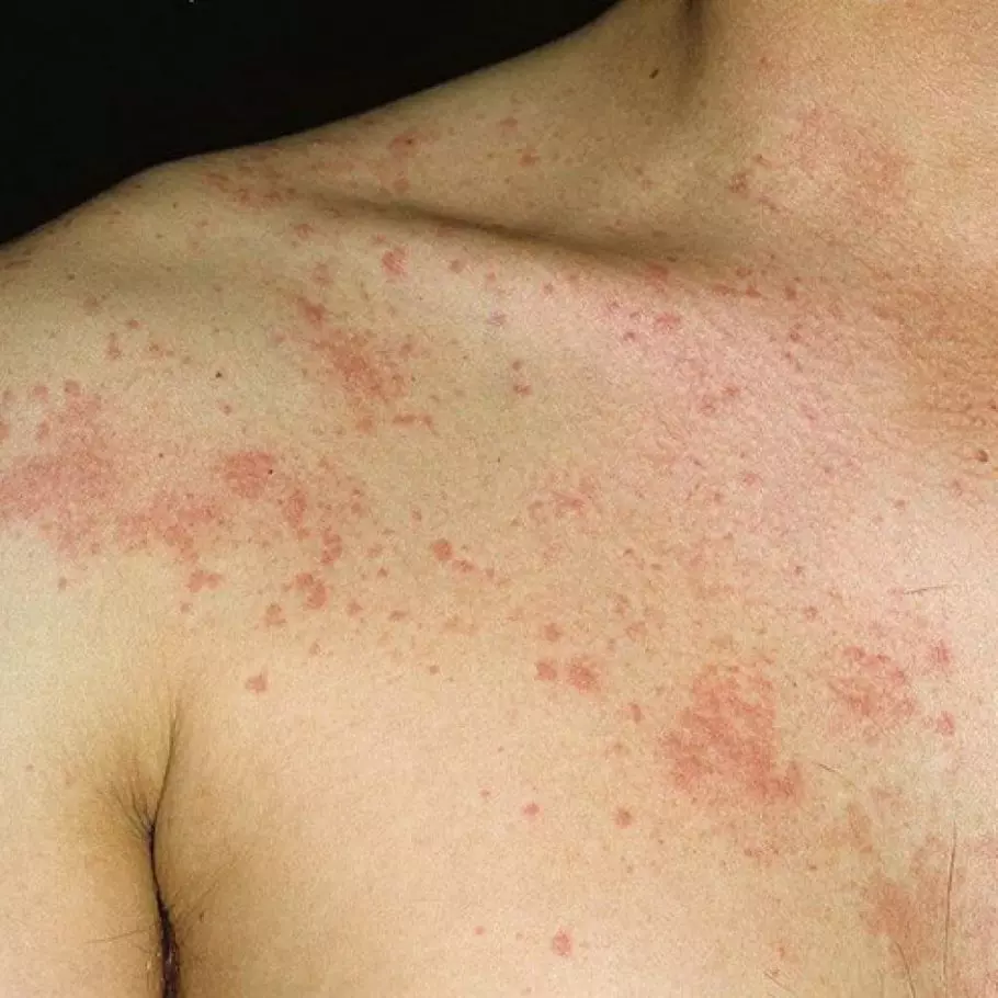 Алергическая реакция на теле