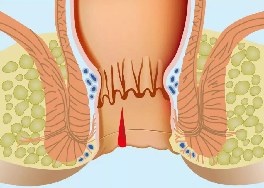 Схематическое отображение геморроидального узла